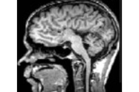 Multisensory interactions in individuals with a congenital absence of the Corpus callosum